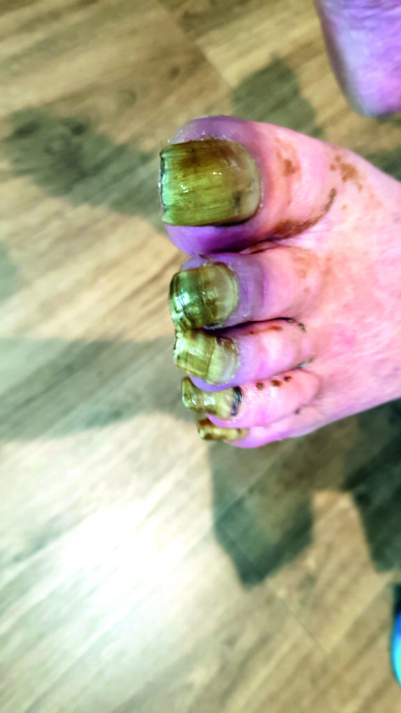 Küüned enne jalahooldust. Foto: Erakogu